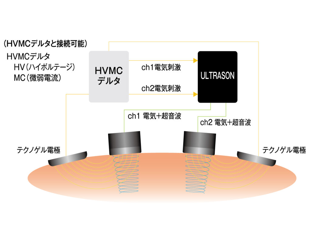 ULTRASON RE-3000